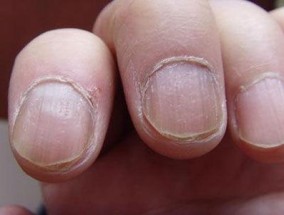 灰指甲初期症状图片（灰指甲7种症状）
